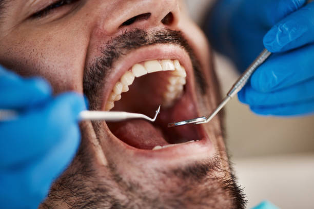 Best Emergency Tooth Extraction in Burlington, OH